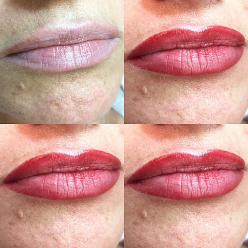 Lip Treatment Result 2