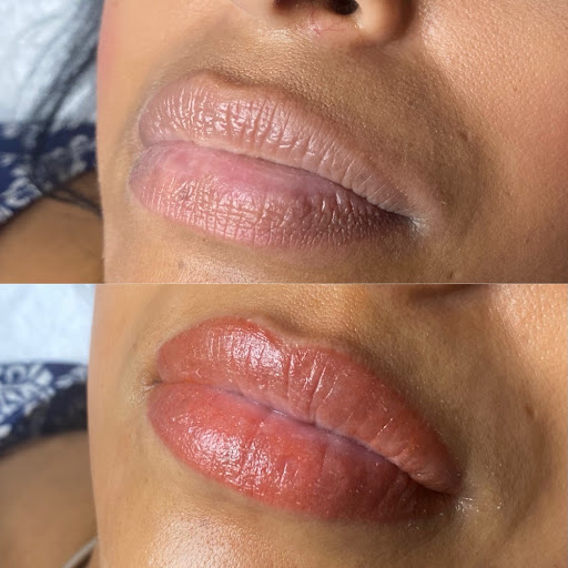 Lip Treatment Result 3